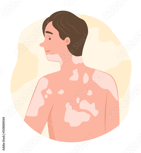 Young Man with Vitiligo Disease on Body Skin for Dermatological Symptom Concept Illustration Clip Art