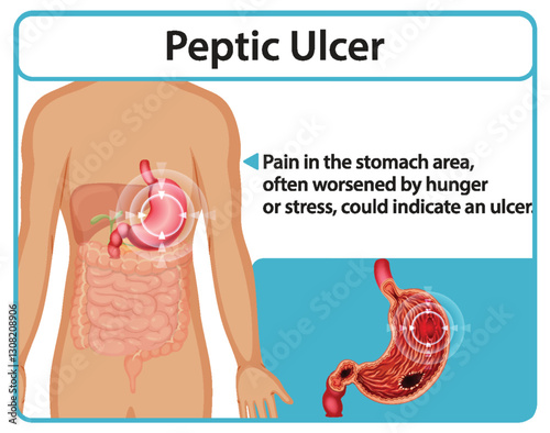 Understanding Peptic Ulcers and Symptoms