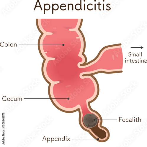 虫垂炎のイラスト appendiciti illustration