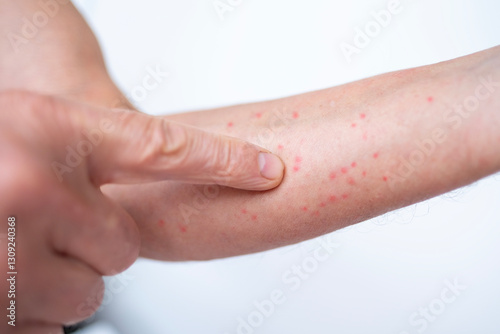 Close up male hand with red skin rash, Dermatology concept, allergic response, Hives, chronic Psoriasis, Drug eruption