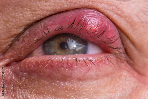 close up of disease barley on the eye. redness of the skin and inflammation of the hair follicle of the eyelash with suppuration. golden staphylococcus. hordeolum. decreased immunity