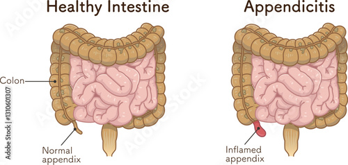 虫垂炎のイラスト appendiciti illustration