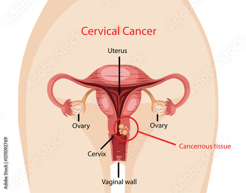 Cervical Cancer Illustration