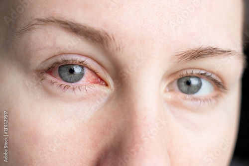 Close up of female face with one red eye suffering from infection conjunctivitis