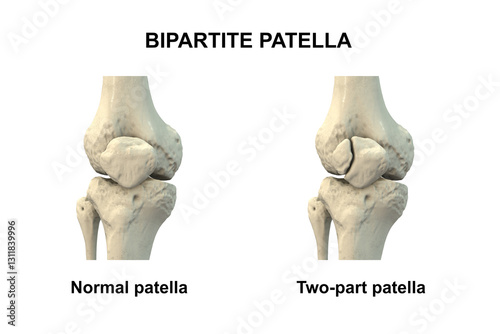 Bipartite patella, a condition where the kneecap has an unfused accessory ossification center, usually superolateral, 3D illustration.