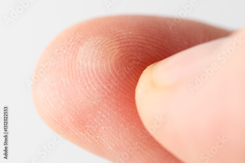 Injured with blister human finger