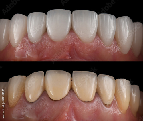 emax ceramic veneers