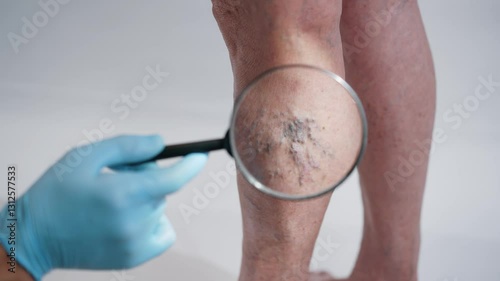 Doctor Closely Inspecting Varicose Veins with Magnifying Tool