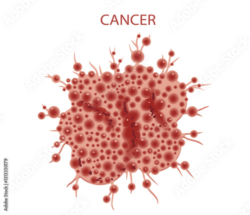 Illustration of metastatic cancer cells