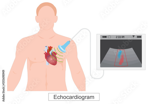 An echocardiogram (echo) is a test that diagnoses and manages heart disease.