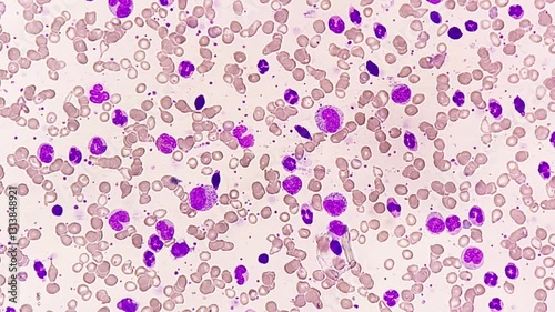 Micrographic footage showing Chronic myelogenous leukemia (CML), also known as chronic myeloid leukemia, is a cancer of the white blood cells. chronic granulocytic leukemia.