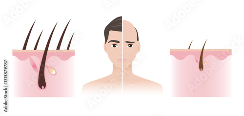 Comparison of man with thick hair and baldness illustration. The difference between healthy hair follicle and miniaturization with scalp layer. Male pattern baldness or androgenetic alopecia.