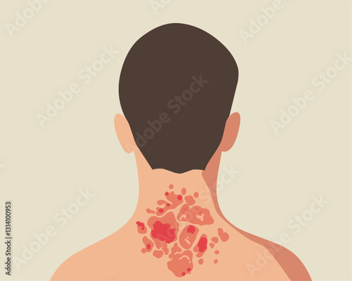 Illustration of psoriasis on the nape of a man. Depicts scaly, red, and inflamed skin. Ideal for medical, dermatology, and health related designs