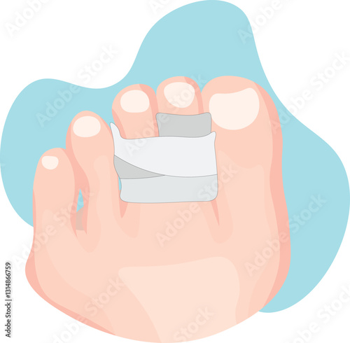  buddy splint is a simple orthopedic device used to immobilize and support an injured finger or toe by taping it alongside an adjacent healthy digit