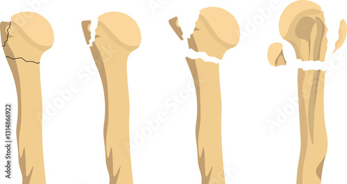 The Neer Classification categorized proximal humerus fractures based on the number of displaced fracture parts of the humeral head, greater tuberosity, lesser tuberosity, and shaft.