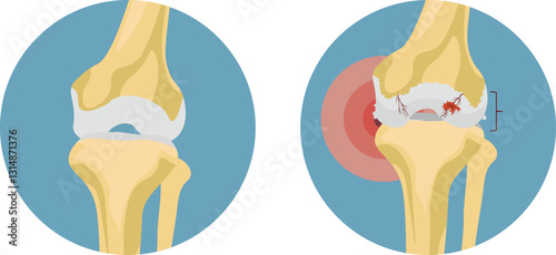 Osteoarthritis is the most common form of arthritis, characterized by the gradual degeneration of joint cartilage and underlying bone, leading to joint pain, stiffness, swelling, and reduced mobility