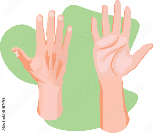 normal hand dorsal and palmar view 