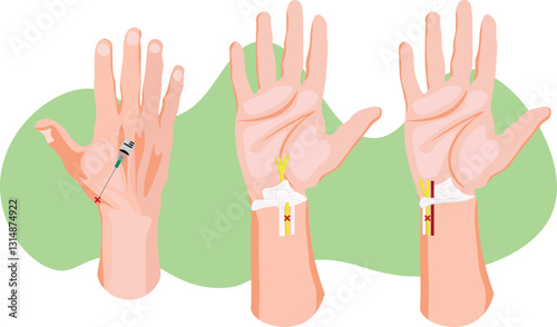 A wrist block is a regional anesthesia technique used to numb the hand and wrist area during surgical or diagnostic procedures typically targeting the radial, ulnar, and median nerves