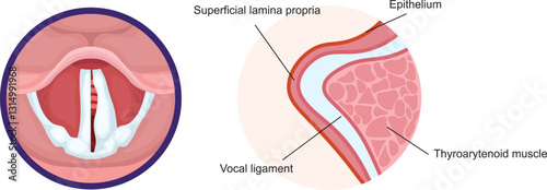 Medialisation of the vocal cord is a surgical procedure used to treat unilateral vocal cord paralysis to reposition the paralyzed vocal cord closer to the midline to improve voice quality