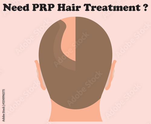 PRP (Platelet-Rich Plasma) hair treatment is a non-surgical, regenerative therapy for hair loss that uses the patient’s own blood components to stimulate hair growth.