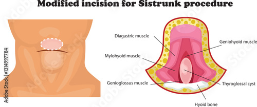 The Sistrunk procedure is a surgical technique used to remove a thyroglossal duct cyst, a common congenital neck mass.