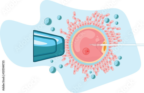 In Vitro Fertilization is an assisted reproductive technology that involves fertilizing an egg with sperm outside the body in a laboratory setting. 