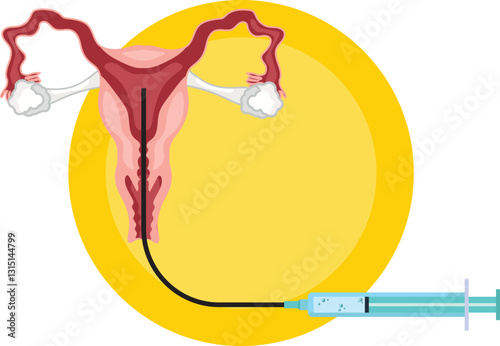 Intrauterine insemination involves directly placing sperm into a woman’s uterus to facilitate fertilization and increase the chances of pregnancy