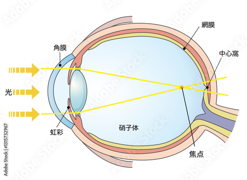 軸性近視の図解イラスト