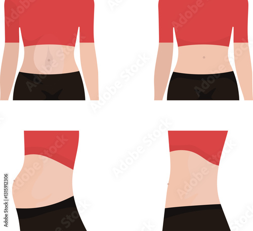 diastasis recti, external and internal view, normal and abnormal condition