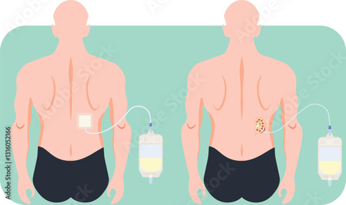 nephrostomy tube on the right renal 