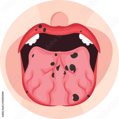 peutz jegher syndrome with hyperpigmentation on the mouth mucosa