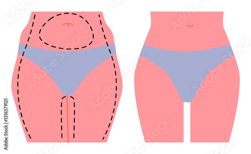 Liposuction Surgery Before and After Comparison.