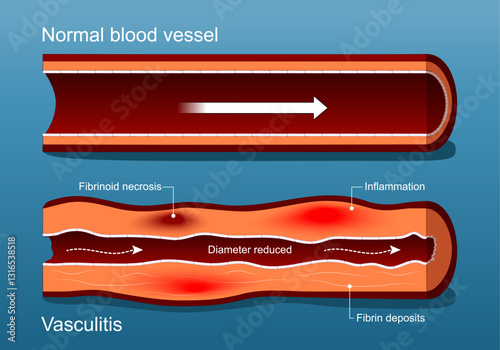 Vasculitis. Autoimmune disease.  Cross section of Blood vessel