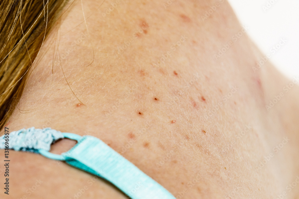 Fototapeta premium Woman with acne pimple on neck.