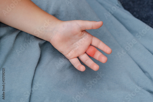 Children hand swollen from wasp sting, insect, reaction to poison