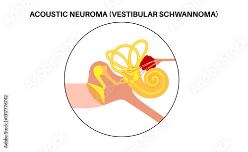 Acoustic neuroma poster