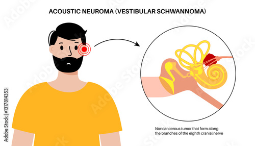 Acoustic neuroma poster
