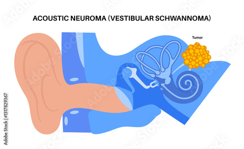 Acoustic neuroma poster