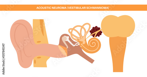 Acoustic neuroma poster
