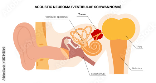 Acoustic neuroma poster