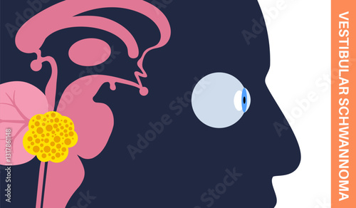 Acoustic neuroma poster