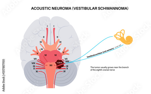 Acoustic neuroma poster