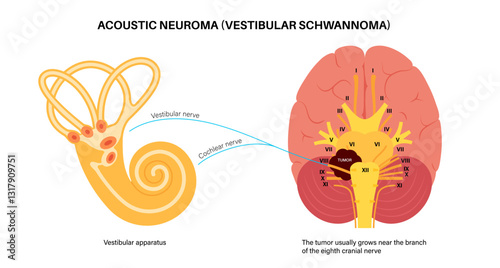 Acoustic neuroma poster