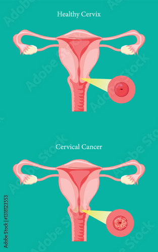 Medical diagram highlighting cervical cancer symptoms and normal cervix structure.