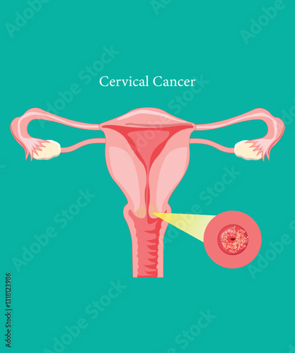 Cervical cancer awareness medical diagram on a green background. eps 10