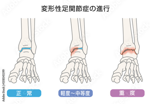 変形性足関節症の進行　イラスト