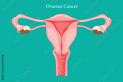 Medical illustration showing ovarian cancer on green background. Eps 10