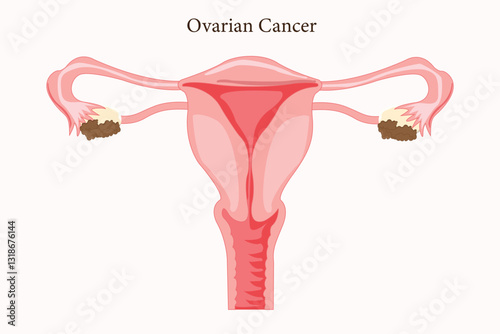 Ovarian cancer diagram showing tumor growth in the ovaries. Eps 10