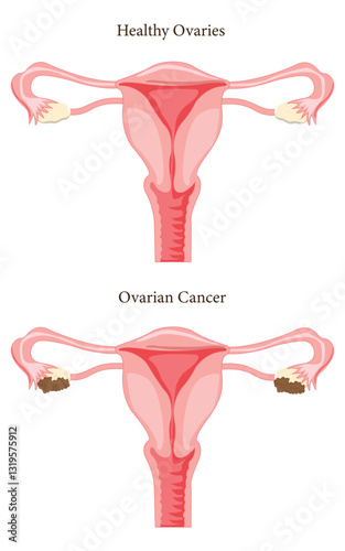 Medical illustration showing ovarian cancer versus normal ovary anatomy. Eps 10