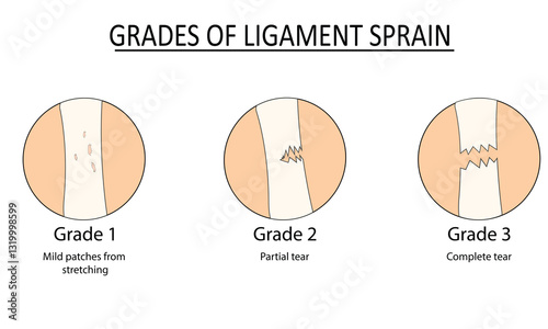 Grades of ligament sprain vector